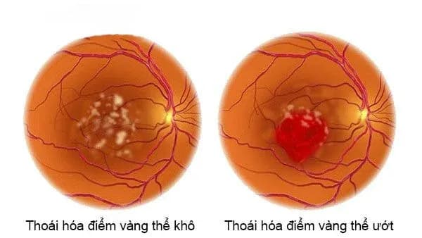 Thoái hóa điểm vàng: Nguyên nhân, triệu chứng và cách điều trị
