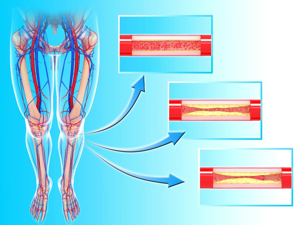 Bệnh động mạch ngoại biên: Dấu hiệu, nguyên nhân và phương pháp kiểm soát