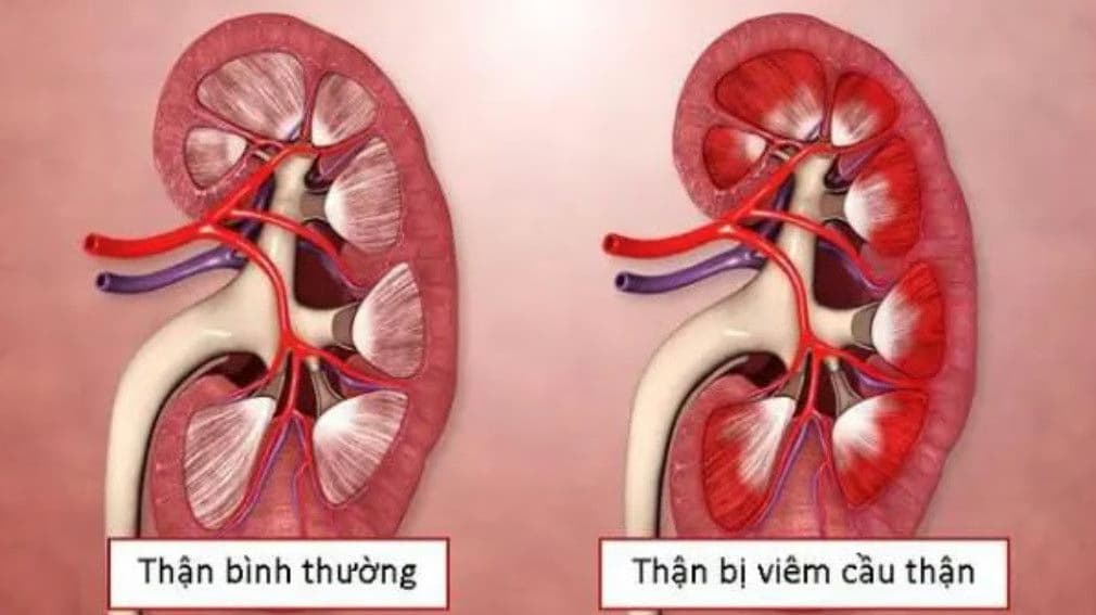 Viêm cầu thận: Nguyên nhân, dấu hiệu, chẩn đoán và cách xử trí