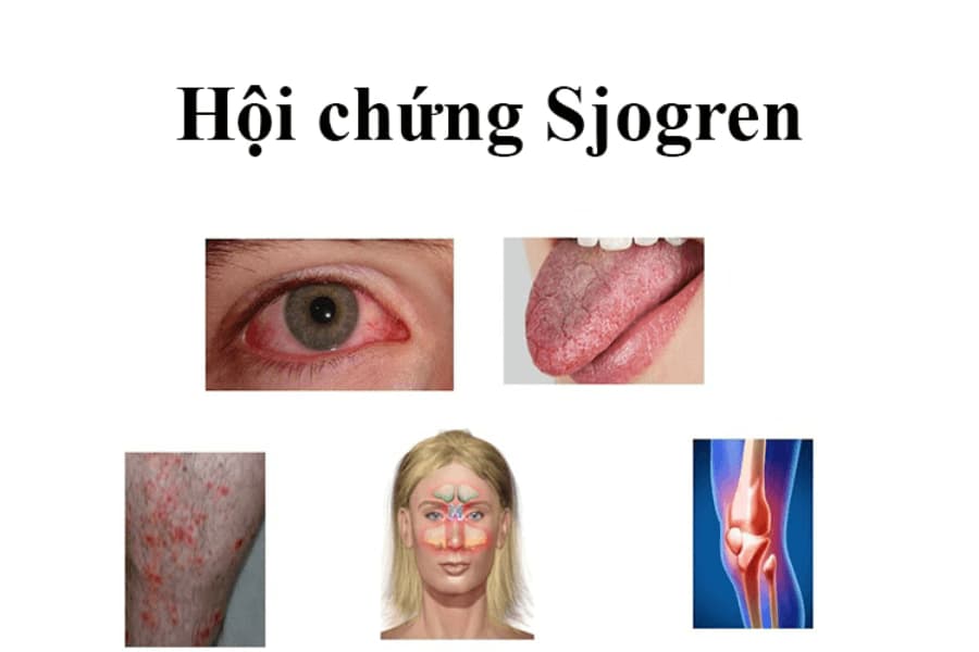 Hội chứng Sjogren