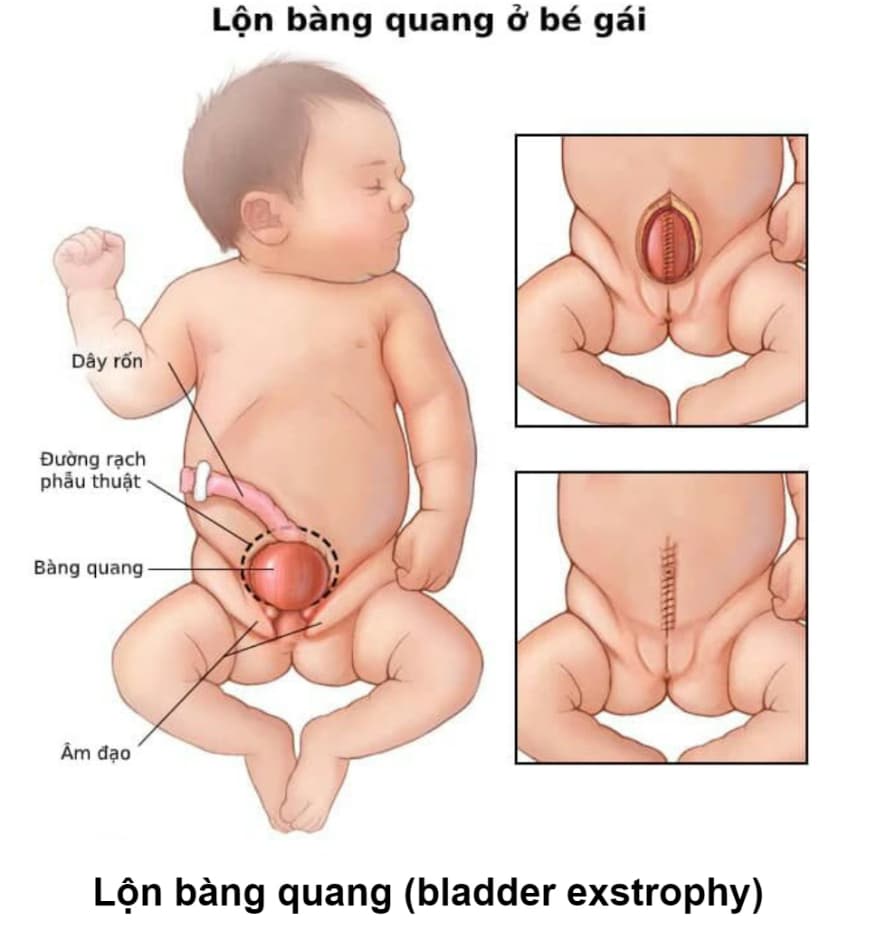 Lộn bàng quang: Nguyên nhân, dấu hiệu và các giai đoạn điều trị