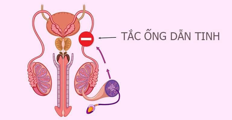 Tắc ống dẫn tinh: Nguyên nhân, dấu hiệu và cách điều trị