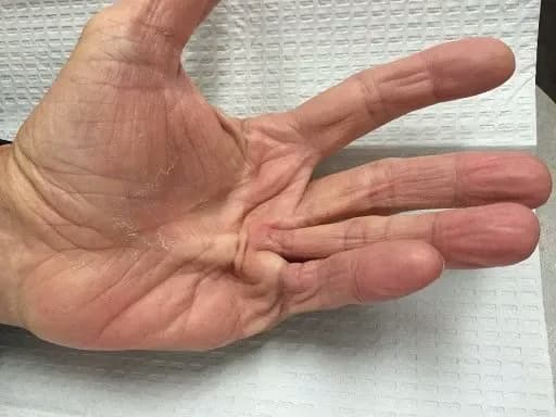 Bệnh co rút Dupuytren: Dấu hiệu, nguyên nhân và các phương pháp can thiệp
