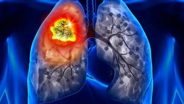 Bệnh bụi phổi atbet (amiăng): Nguyên nhân, triệu chứng, chẩn đoán và cách kiểm soát