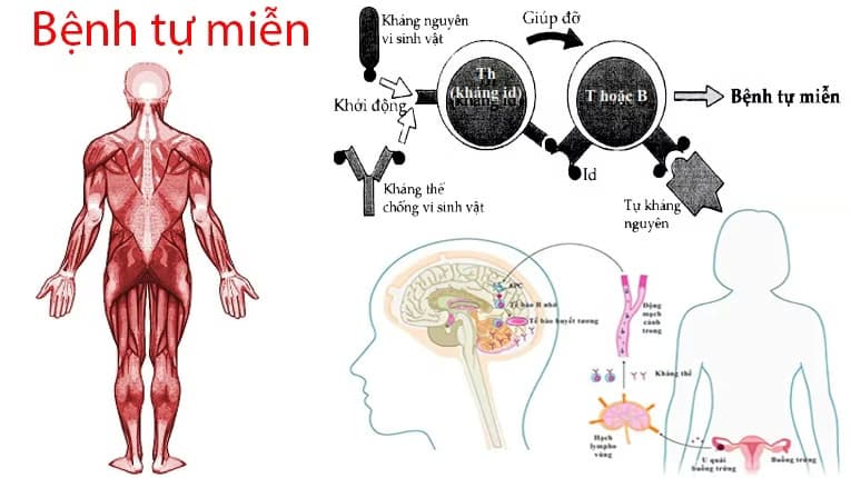 Bệnh tự miễn: Dấu hiệu, nguyên nhân và cách kiểm soát