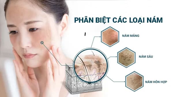 Nám da: Dấu hiệu, nguyên nhân và cách quản lý y khoa