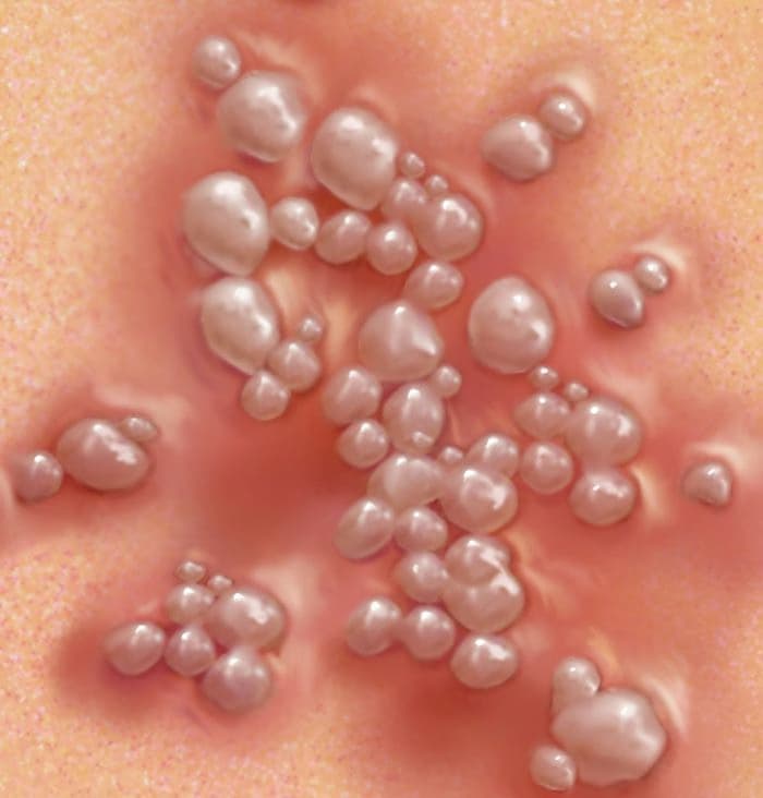 Herpes sinh dục: Nguyên nhân, triệu chứng, đường lây và cách xử trí