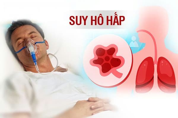 Suy hô hấp: Nguyên nhân, dấu hiệu và cách điều trị