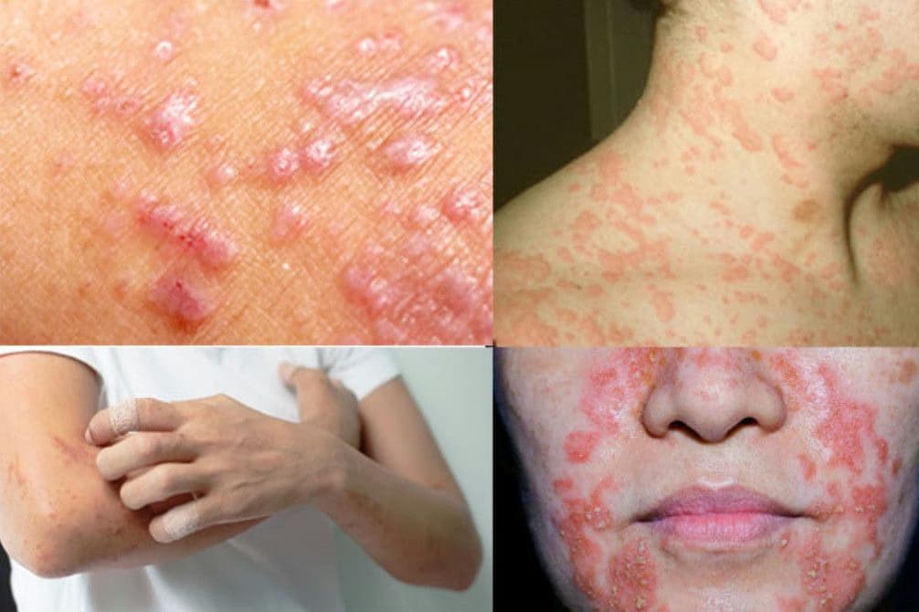 Viêm da cơ địa: Dấu hiệu, nguyên nhân và cách kiểm soát