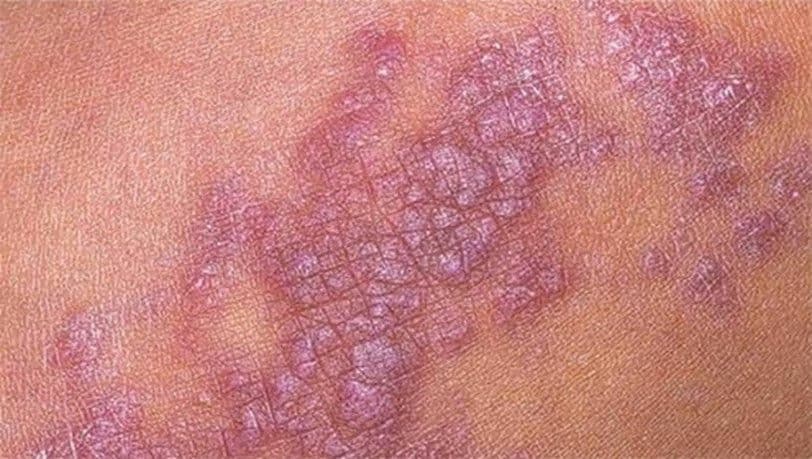 Dày sừng ánh sáng: Nguyên nhân, dấu hiệu và cách điều trị
