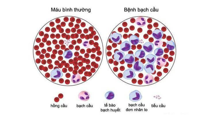 Ung thư máu: Nguyên nhân, dấu hiệu và cách điều trị