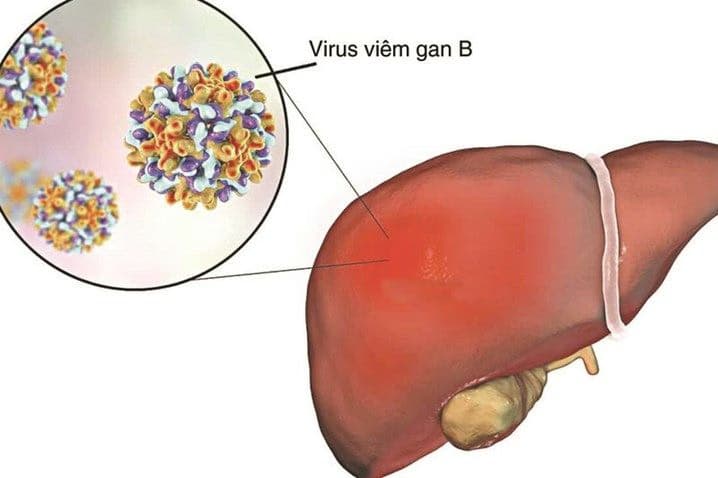 Viêm gan B: Nguyên nhân, triệu chứng, chẩn đoán và cách điều trị