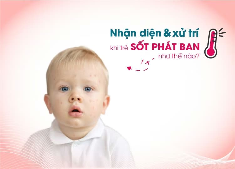 Sốt phát ban: Dấu hiệu, nguyên nhân và nguyên tắc chăm sóc y khoa