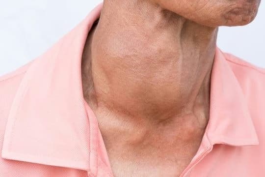 Bướu giáp lan tỏa: Phân loại, nguyên nhân, triệu chứng và phương pháp chẩn đoán