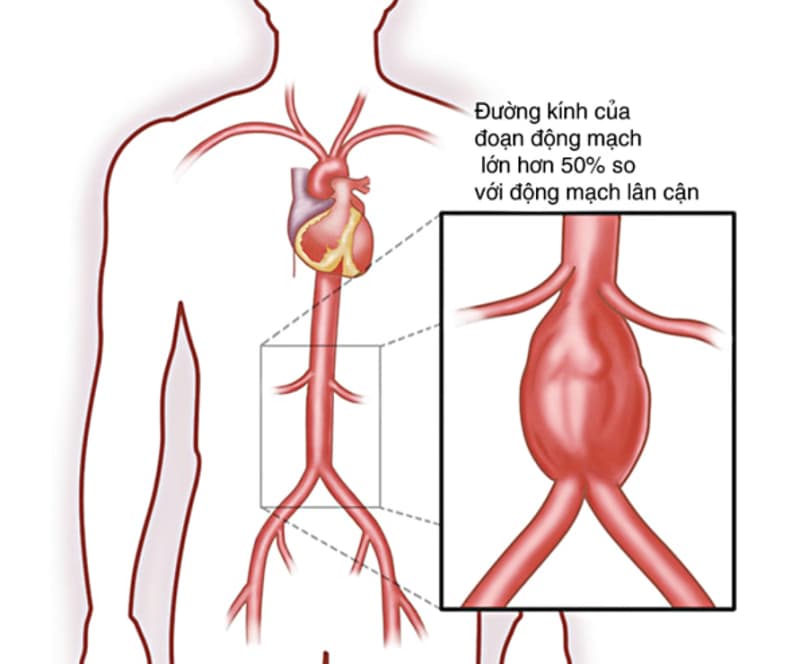 Viêm động mạch chủ: Nguyên nhân, triệu chứng, chẩn đoán và cách điều trị