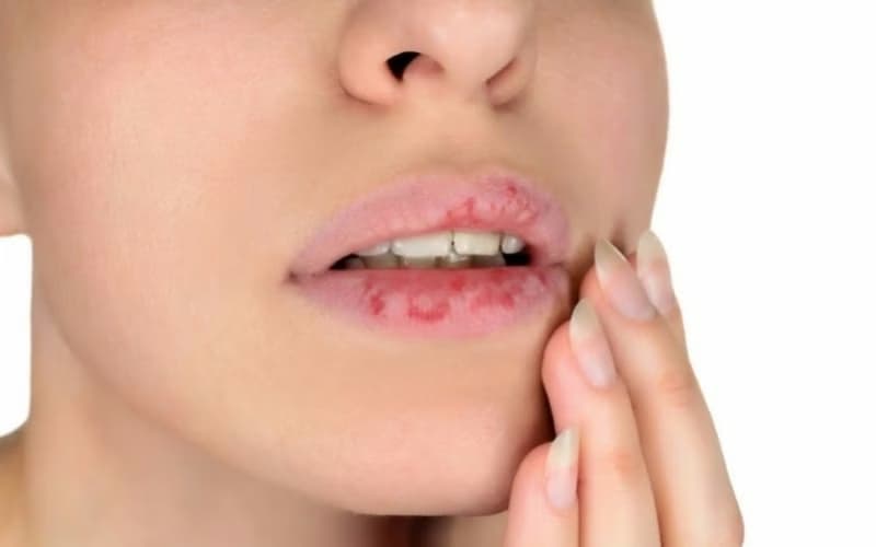 Bệnh chàm môi: Nguyên nhân, triệu chứng và phương pháp chẩn đoán