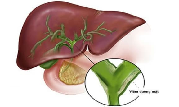 Viêm đường mật nguyên phát (PBC): Nguyên nhân, triệu chứng và cách điều trị