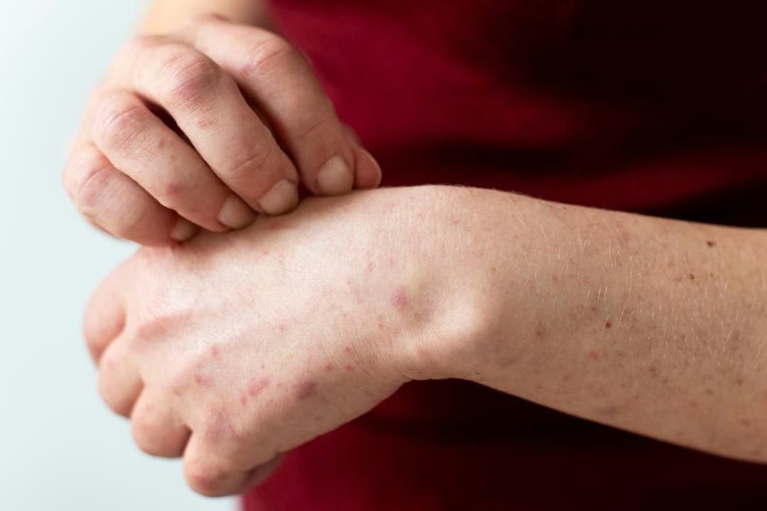 Dày sừng nang lông: Nguyên nhân, triệu chứng và cách chăm sóc