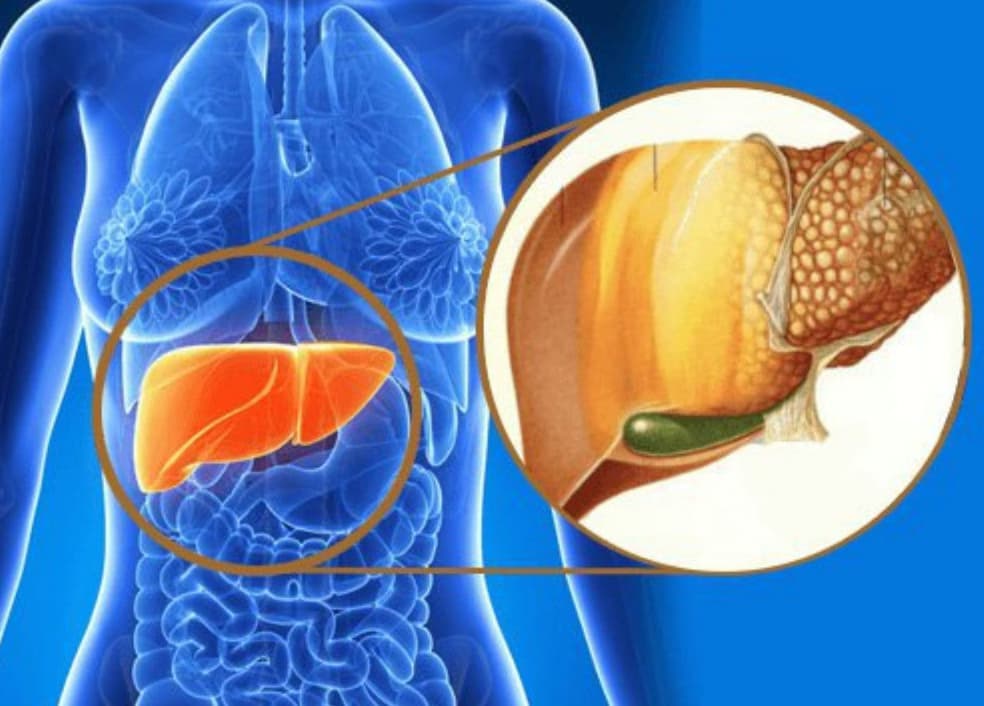 Bệnh gan nhiễm mỡ không do rượu: Nguyên nhân, dấu hiệu và cách điều trị