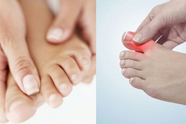 Viêm khớp ngón chân: Nguyên nhân, dấu hiệu và cách điều trị