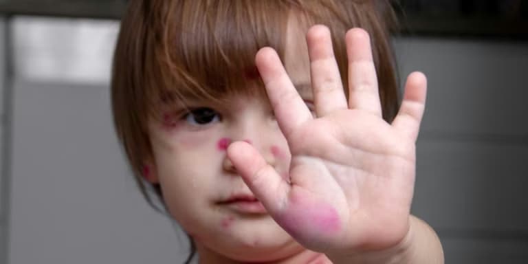 Bệnh thủy đậu: Dấu hiệu, đường lây, biến chứng và cách chăm sóc