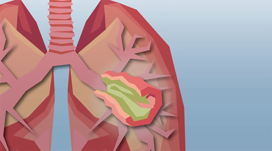 Bệnh xơ nang (Cystic Fibrosis): Nguyên nhân, triệu chứng và cách điều trị