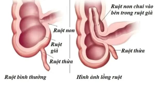 Bệnh lồng ruột: Nguyên nhân, dấu hiệu và cách điều trị
