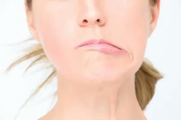 Bệnh liệt mặt: Nguyên nhân, dấu hiệu, cách điều trị và phòng ngừa