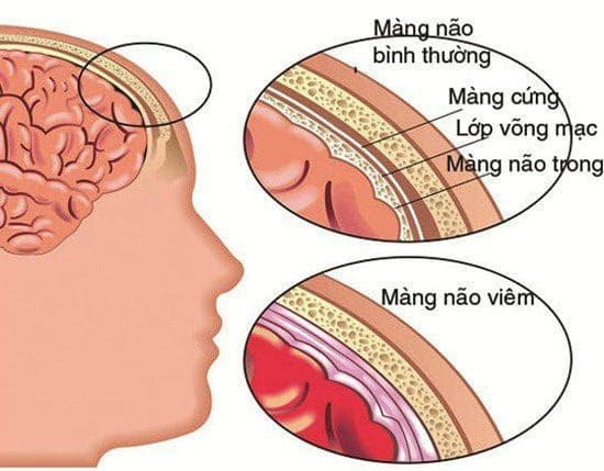 Viêm não tự miễn: Nguyên nhân, triệu chứng và cách điều trị