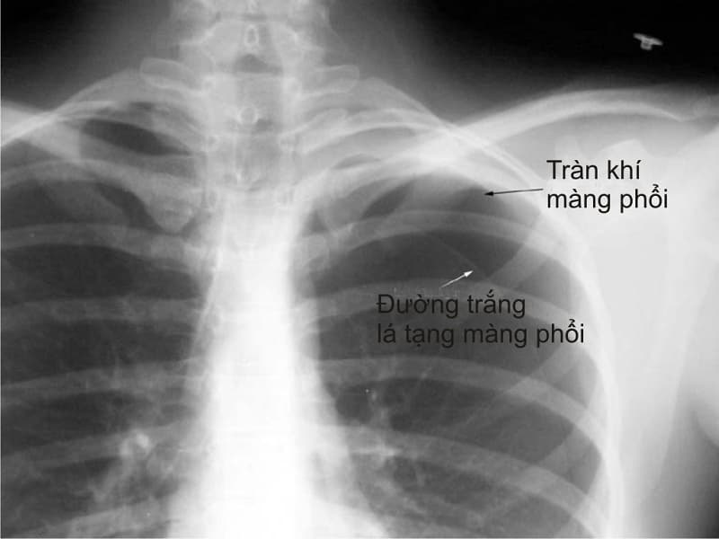 Tràn khí màng phổi: Nguyên nhân, triệu chứng và cách điều trị
