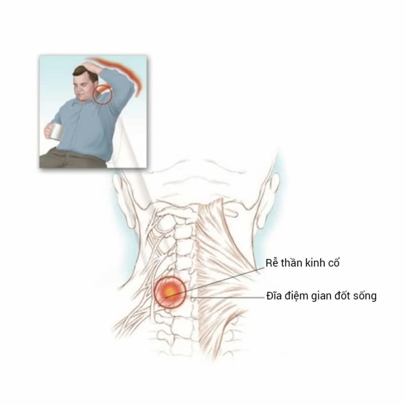 Bệnh rễ thần kinh: Nguyên nhân, dấu hiệu và cách xử trí