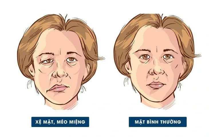 Liệt mặt ngoại biên: Nguyên nhân, dấu hiệu và cách xử trí