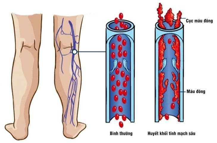 Huyết khối tĩnh mạch sâu: Nguyên nhân, dấu hiệu và giải pháp quản lý