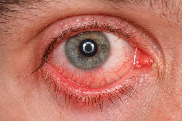 Bệnh glôcôm góc mở: Dấu hiệu, nguyên nhân và quy trình chẩn đoán