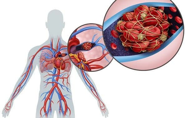Thuyên tắc phổi (tắc động mạch phổi): Nguyên nhân, dấu hiệu và cách điều trị