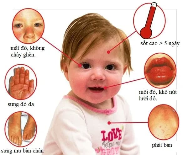 Bệnh Kawasaki ở trẻ em: Dấu hiệu, chẩn đoán và cách điều trị