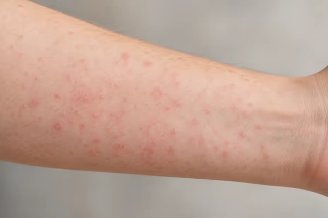 Bệnh sởi mấy ngày khỏi và diễn tiến hồi phục