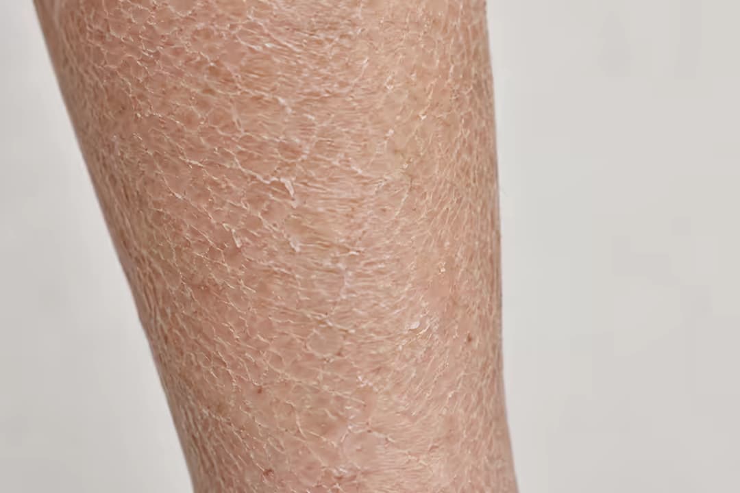 Bệnh vảy cá có lây không và các phương pháp chăm sóc da
