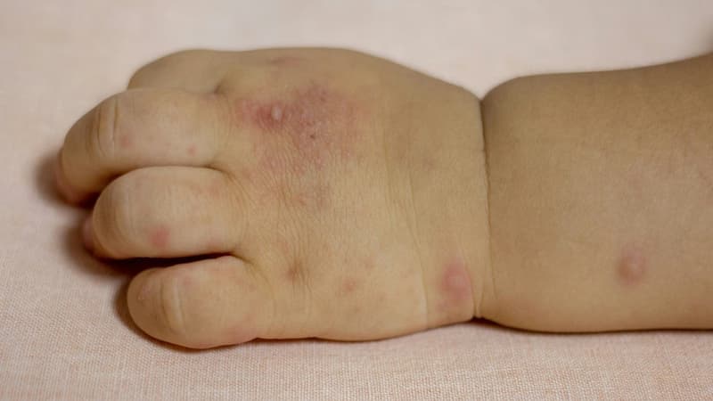 Mức độ nguy hiểm và cách phòng ngừa biến thể C1 của virus EV71 gây tay chân miệng