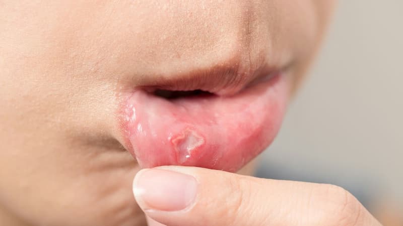Có nên bôi thuốc vào vết loét tay chân miệng ở trẻ không