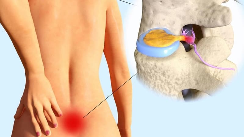 Các cách điều trị thoát vị đĩa đệm L4 L5 theo từng giai đoạn