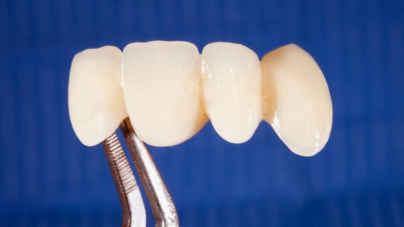 Cầu răng sứ là gì? Ưu nhược điểm, quy trình và trường hợp nên thực hiện