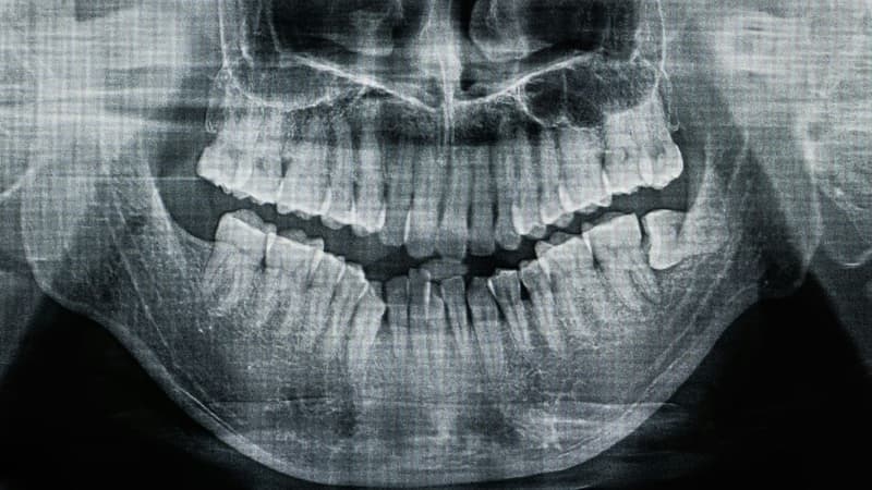 Chân răng dùi trống: Nguyên nhân, ảnh hưởng và cách xử trí