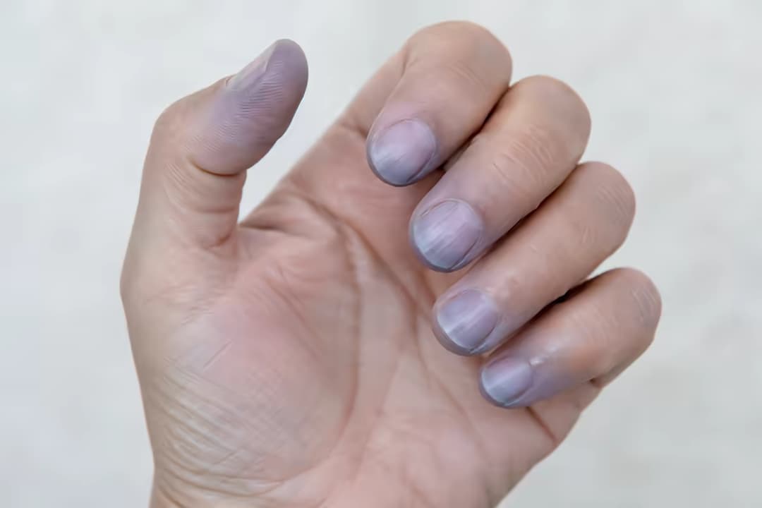 Da xanh tím cảnh báo bệnh gì và cách xử trí đúng cách