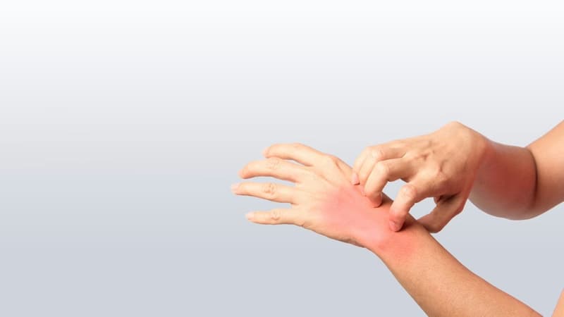 Dị ứng thức ăn bao lâu thì hết và cách xử trí