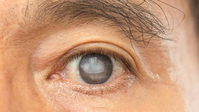 Đục thủy tinh thể do tiểu đường: Nguyên nhân, triệu chứng và cách phòng ngừa