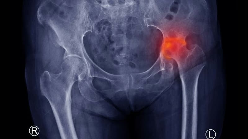 Hình ảnh viêm khớp háng qua các giai đoạn và phương pháp chẩn đoán