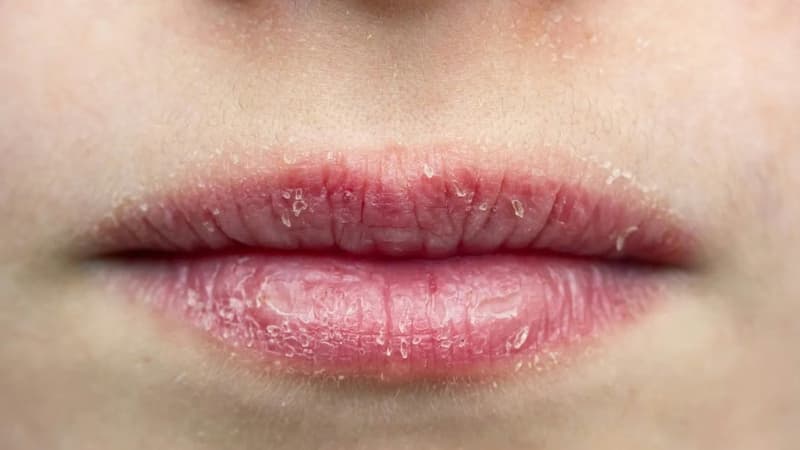 Khô rát viền môi: Nguyên nhân thường gặp và cách cải thiện