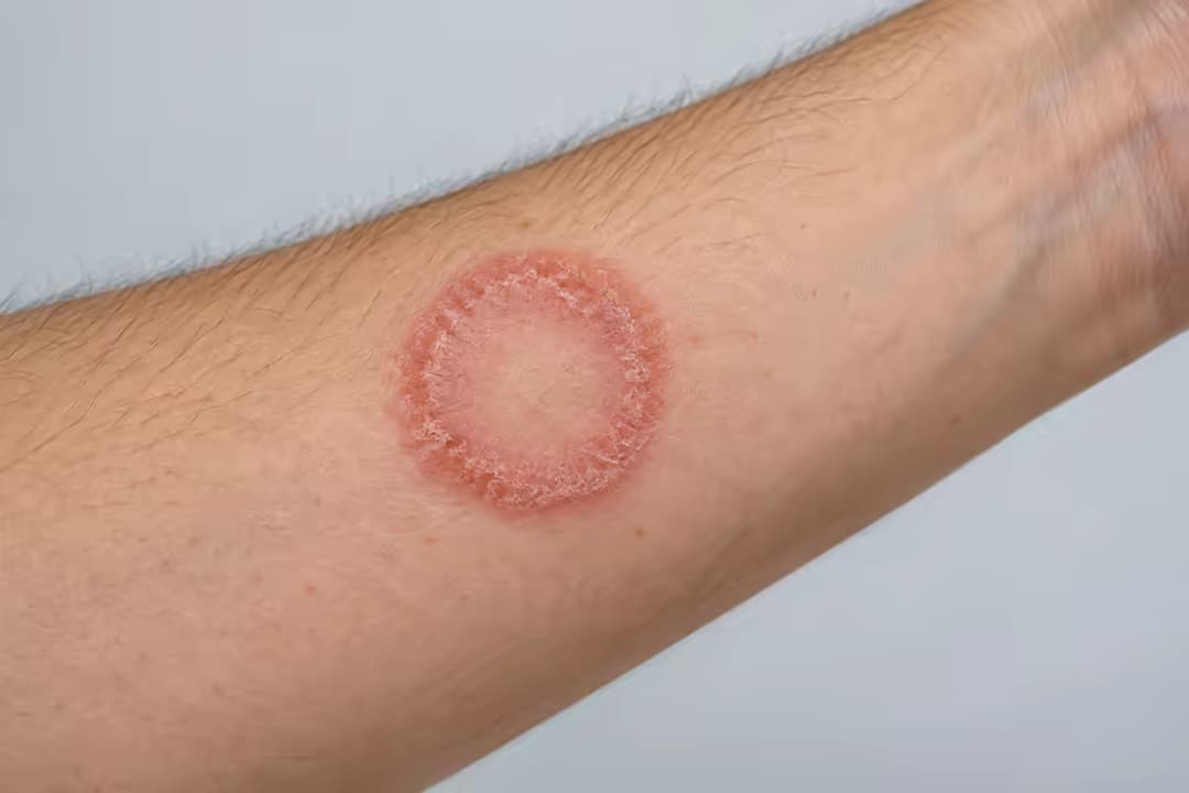 Lác đồng tiền: Nguyên nhân, biểu hiện và cách chăm sóc da nhiễm nấm
