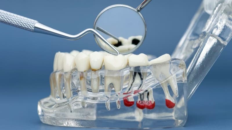 Chi phí lấy tủy răng số 7 bao nhiêu tiền và các lưu ý cần biết